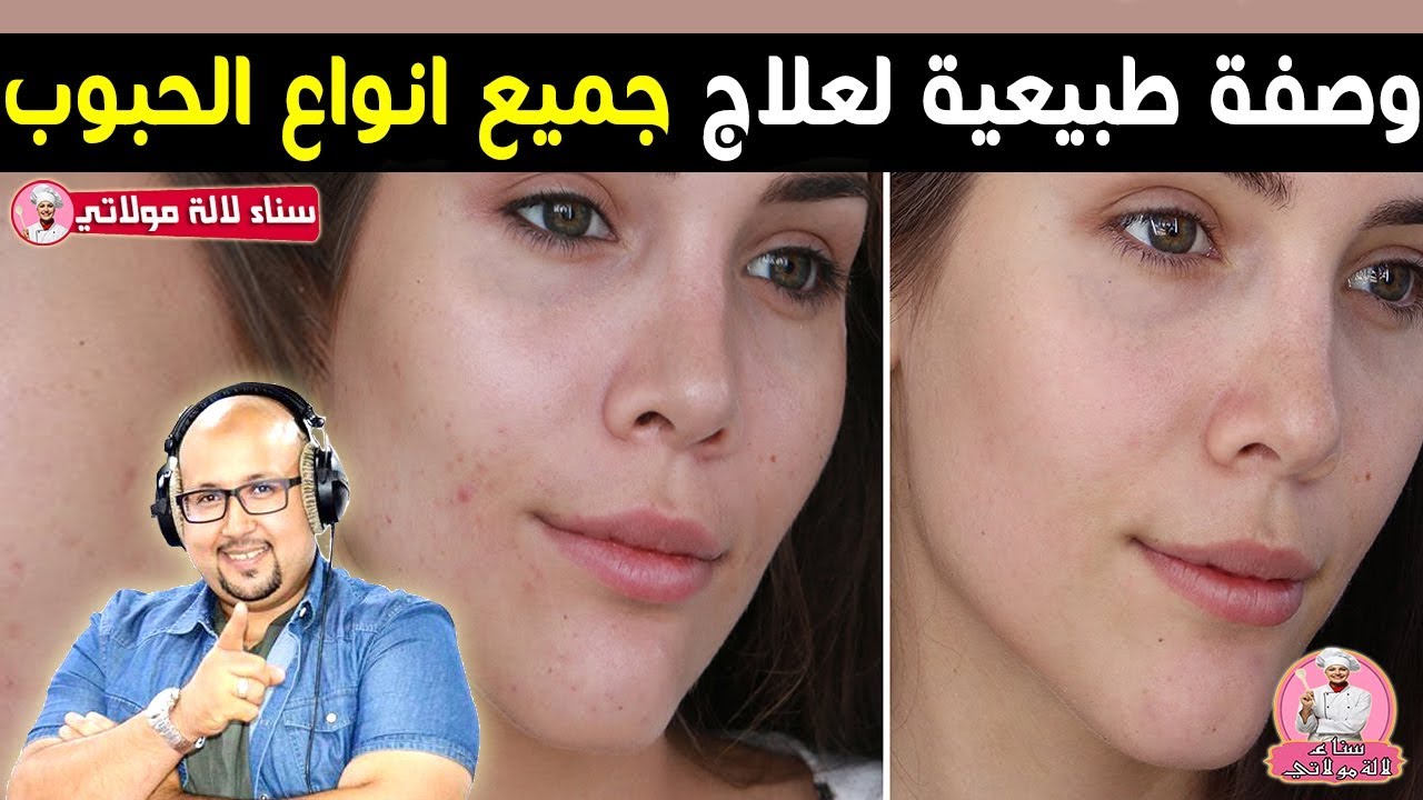 وصفة طبيعية لعلاج جميع انواع الحبوب في البشرة من الدكتور عماد ميزاب imad mizab