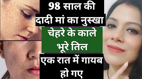 चेहरे के पुराने से पुराने काले भूरे तिल1रात में हटाएं |How to remove mole From Face|तिल कैसे हटाएं