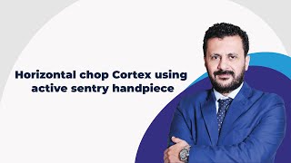 Horizontal chop Cortex using active sentry handpiece