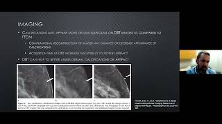 Calcifications on Tomosynthesis Overview