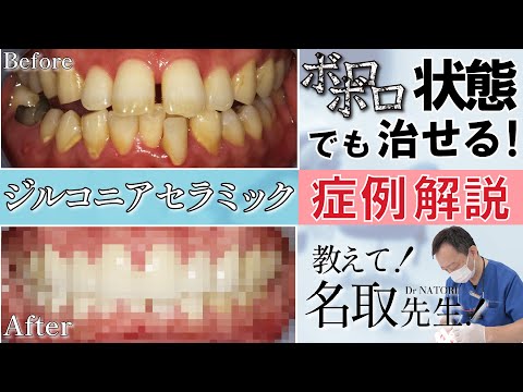 【セラミック矯正】症例解説 ボロボロの歯•異様な歯並びも治せる！【治療解説】