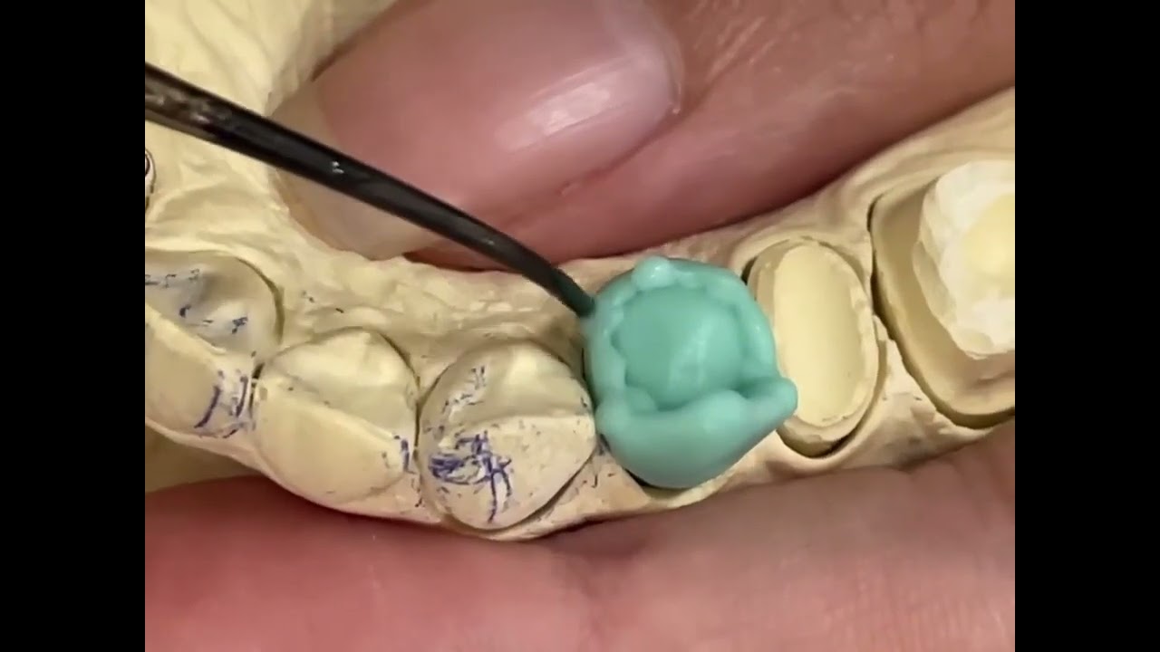 wax up premolar(واكسنك)
