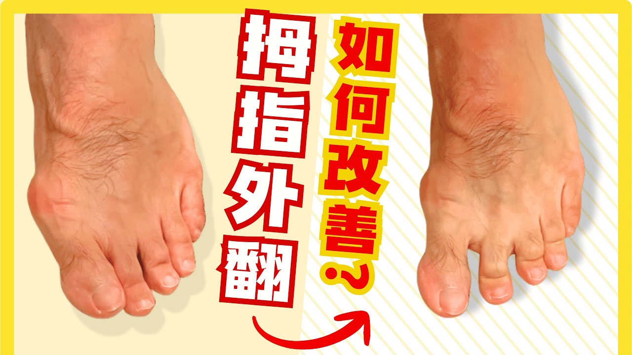 拇指外翻多年無法改善…我竟然這樣解決了！？