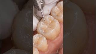 Dentist Fixes Tooth Destroyed by Acid 😱 Satisfying Restoration