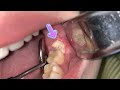 3rd molar extraction.