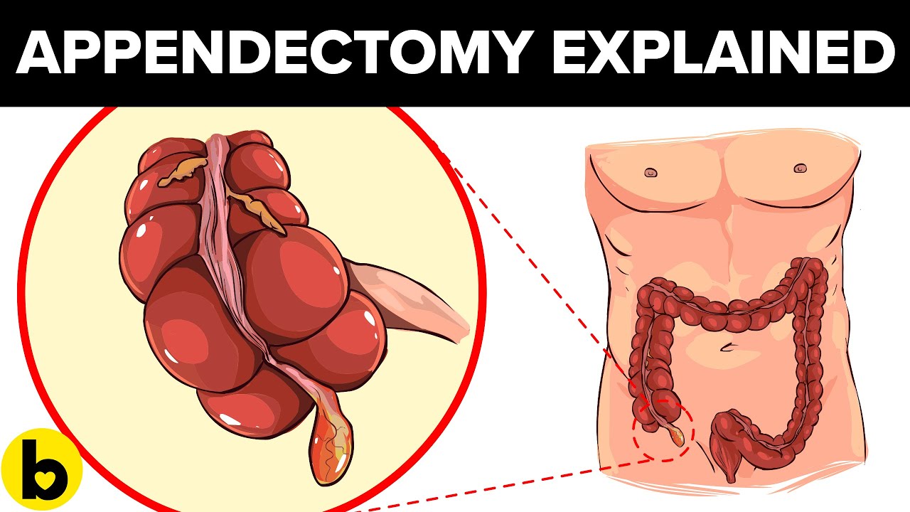 9 Things you should know about an Appendectomy