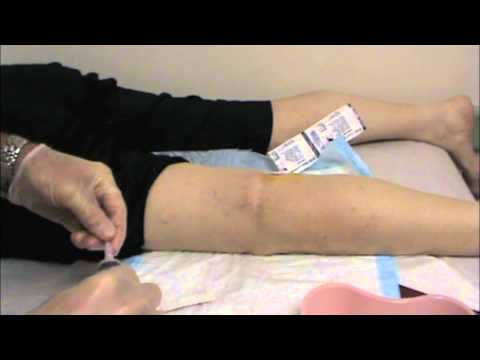 Video: Knie Cyste - Bakker (bakker) Cyste, Behandeling En Operatie