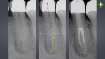 Virtual Realities in Endodontics - SICAT ENDO - Dr. Tomas Lang