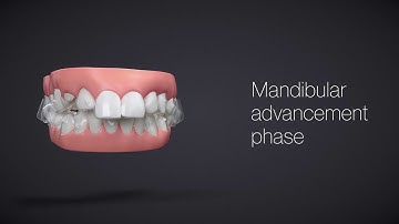 Invisalign® Treatment with Mandibular Advancement   How It Works