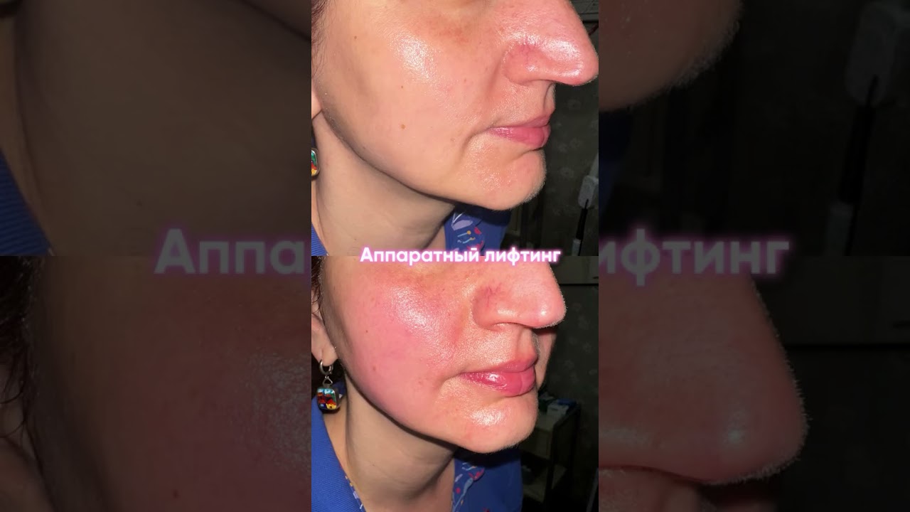 Accent Prime face lift: after 1 session