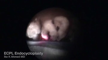 Endocycloplasty (ECPL) for Plateau Iris Angle Closure Glaucoma Ike Ahmed 720pN
