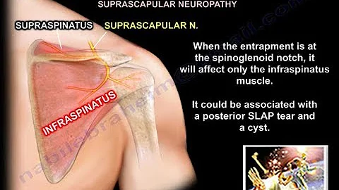 Entrapment Of The Nerves Around The Shoulder - Everything You Need To Know - Dr. Nabil Ebraheim - DayDayNews