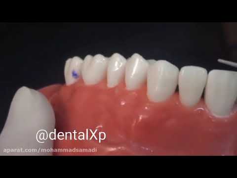 آموزش تراش محافظه کارانه لامینیت دکتر طبری