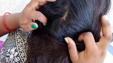 OMG! Hundreds of nitpicking/lice picking/plenty of Tiny eggs with hands//in telugu