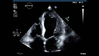 Dilated Cardiomyopathy