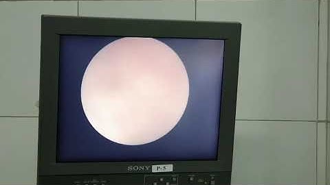 SỎI NIỆU QUẢN/CHỈ CÓ 1 QUẢ THẬN❤ TÁN SỎI NIỆU QUẢN NỘI SOI❤TS.BS.Dương Văn Trung-Tel.0913534343