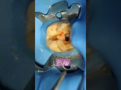 Wideo: Podczas leczenia endodontycznego przepłukiwane są kanały miazgi?