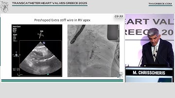 M. Chrissoheris | Imaging pre and post procedure: echocardiography