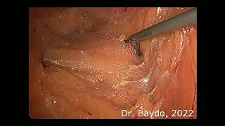 Laparoscopic para-aortal LND for BMI=50