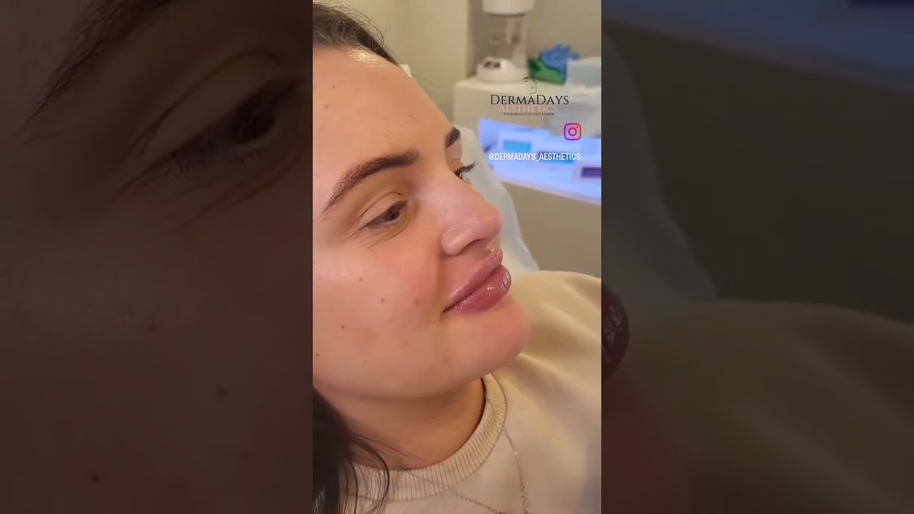 What a BEAUTY❤️A fresh set of lips to create VOLUME, BALANCE & DEFINITION 💉💋 