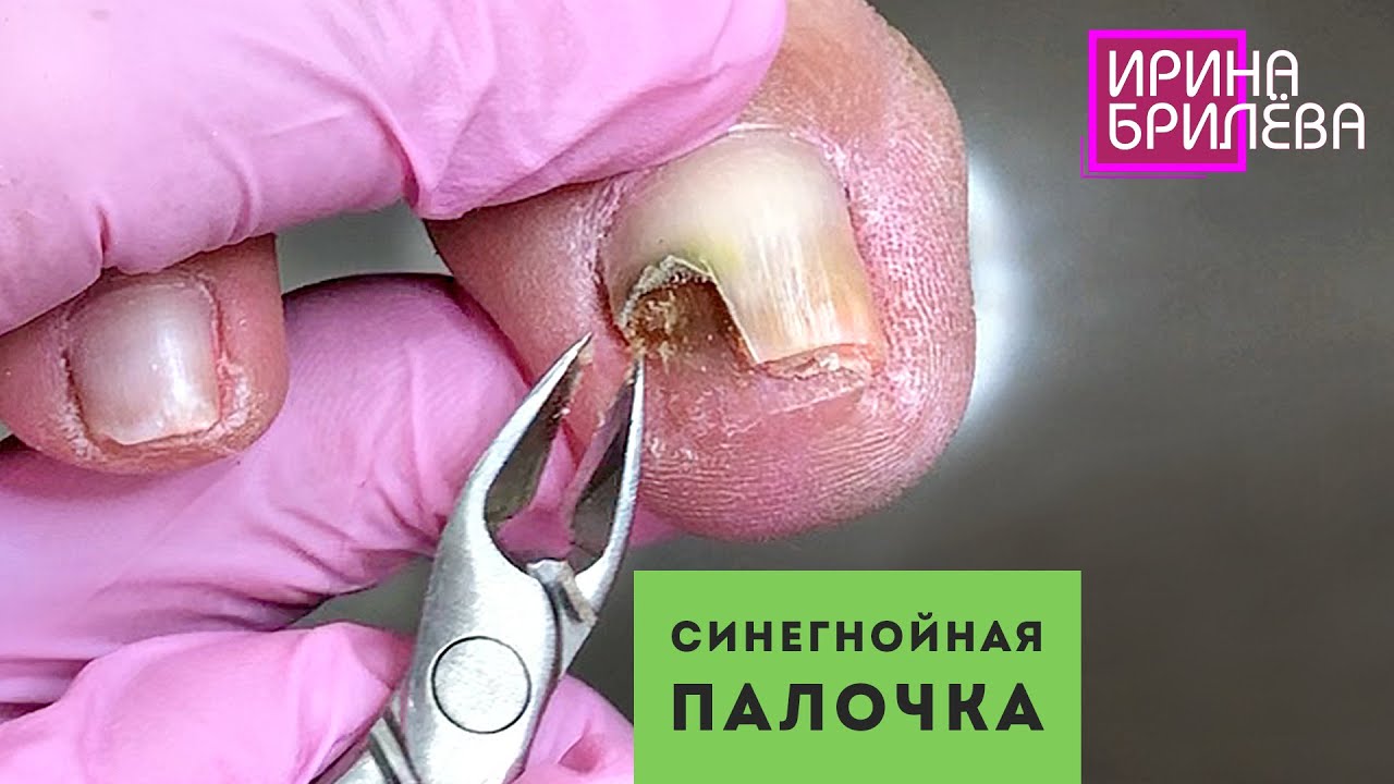 Split nail and infection : r/NailFungus