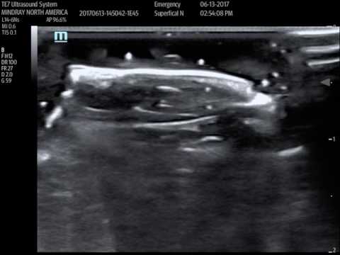 scanning a tooth with ultrasound