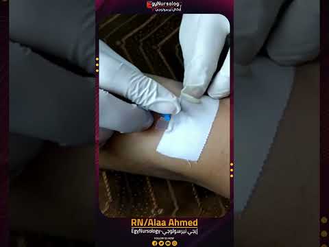 إزالة الكانيولا