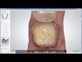 3Shape Dental System - TRIOS スキャンからのフルアナトミカルクラウン