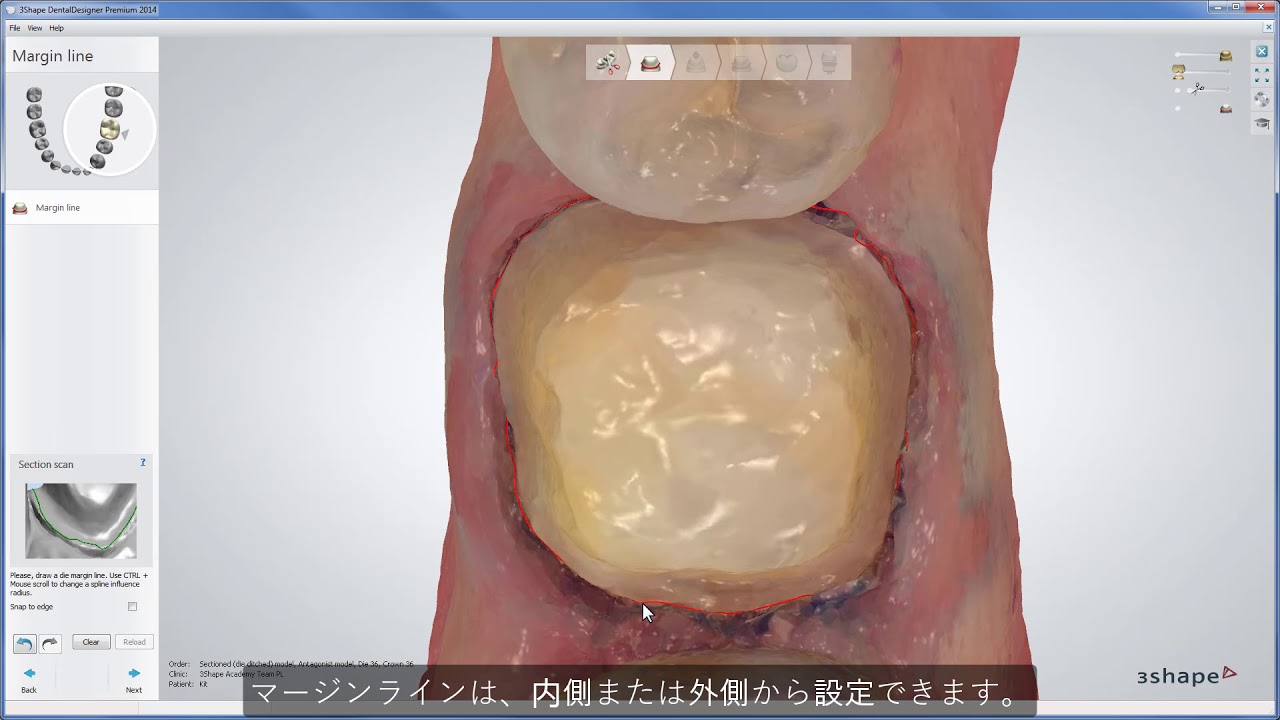 modelbuilder query to view 3Shape Dental System - TRIOS スキャンからのフルアナトミカルクラウン