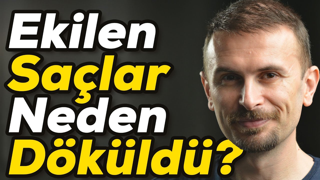 Saç ekimi hakkında her şey | 3 yıl sonra tüm sorularınızı cevaplıyoruz