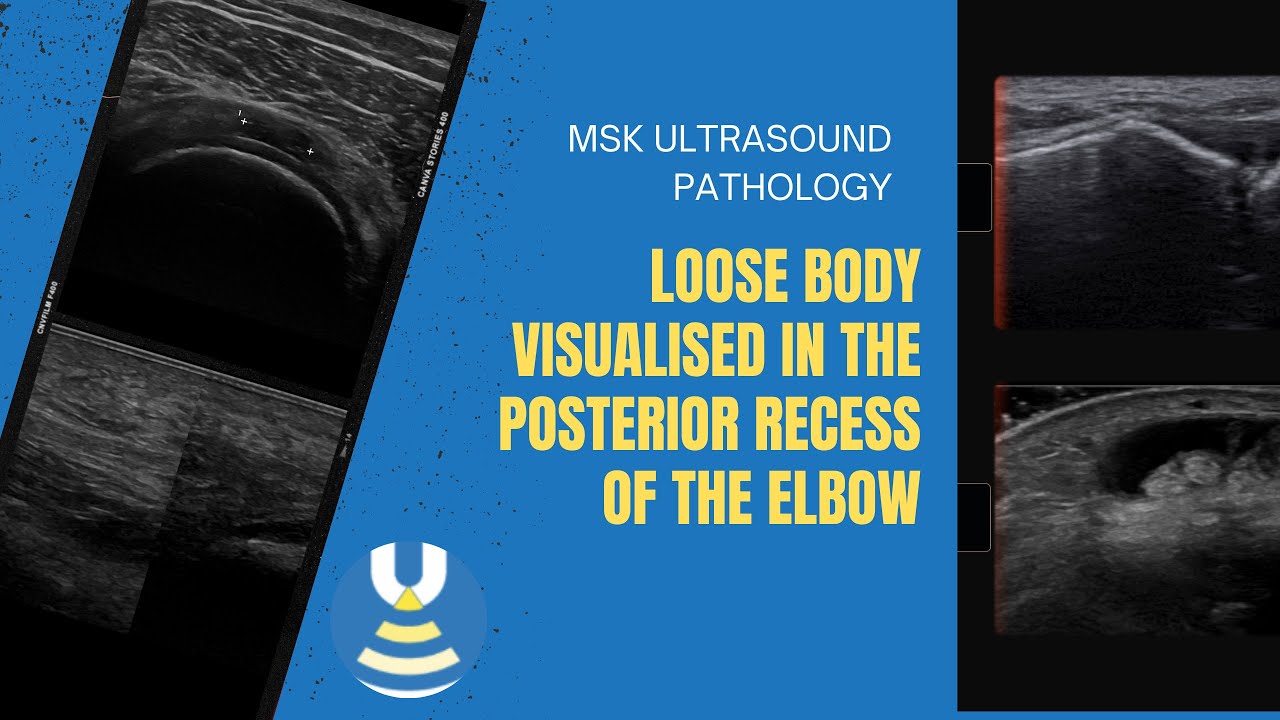 Loose body visualised in the posterior recess of the elbow on ultrasound