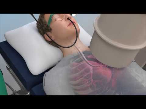CHEST Foundation - Learn About Lung Biopsies