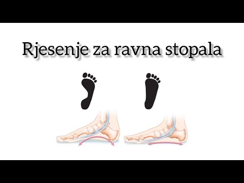 Zašto imam ravna stopala? Rješenje!