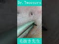 395 Understanding the structure hidden in the beard Dr. tweezers 毛抜き先生の角栓や毛根