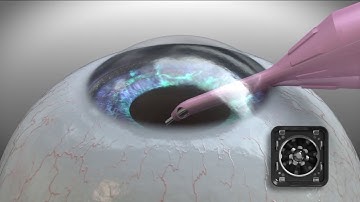 Centurion® Vision System Gravity and Pressurized Fluidics | Lotus Vision, Cataract Surgery