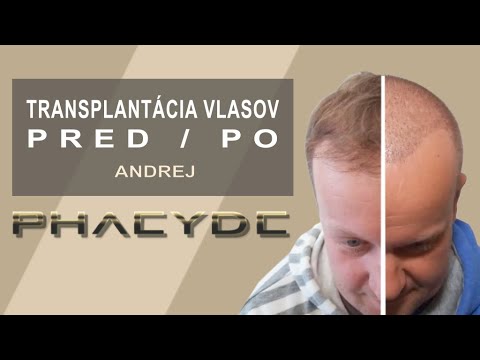 Video: Transplantácia Pre „starý Jerevan“