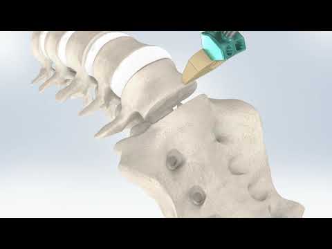 Precision Spine® Vault® ALIF System