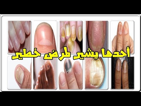 10 ألوان للأظافر تعكس حالتك الصحية أحدها يشير لمرض خطير