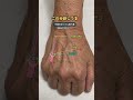 この手背、どの血管を狙う？ルート確保の「刺す場所」と「先端の位置」