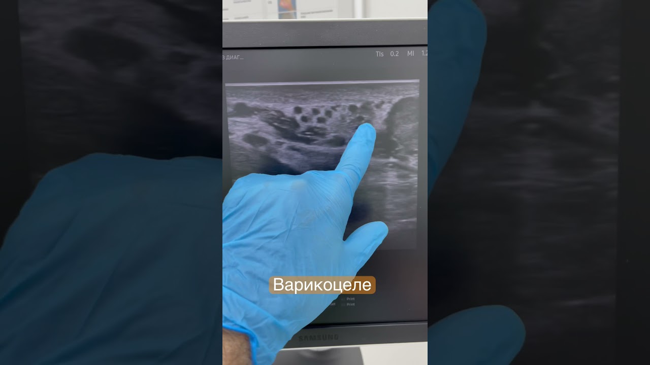 Варикоцеле 4 ст. у молодого человека. Уролог. Флеболог. Москва - YouTube