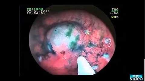 Advanced Endoscopic Imaging for the Detection of Dysplasia in Ulcerative Colitis
