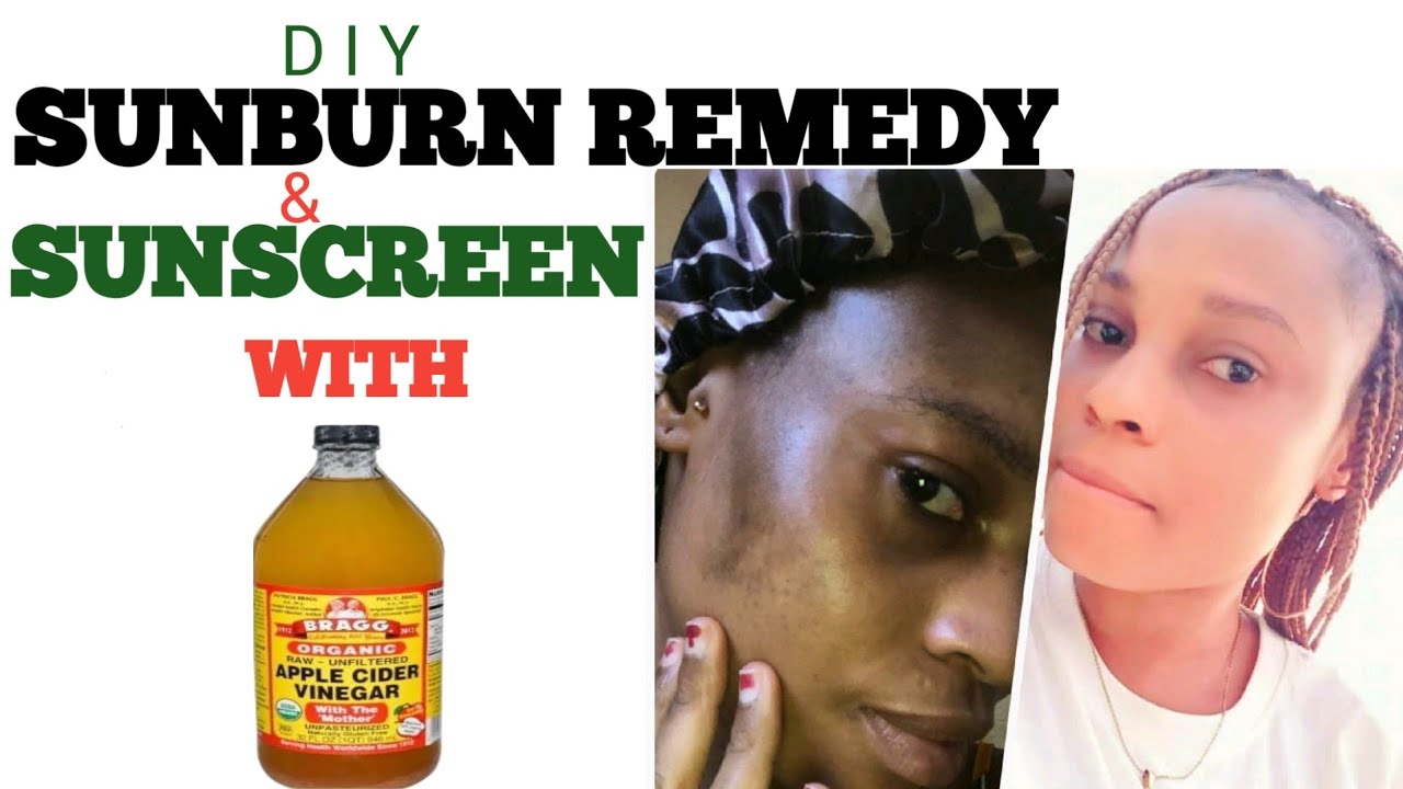 SUNBURN TREATMENTHOMEMADE SUNSCREEN #applecidervinegarforsunburn#diy 