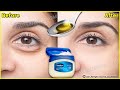 In 3 days Remove Under Eye Bags Completely | Remove Dark Circle, Wrinkles, Puffy Eyes