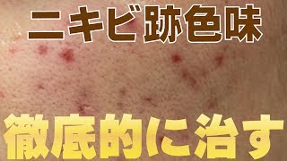 【美容】ニキビ跡で黒・茶色・色素沈着してしまった肌を徹底的に治す方法教えます。