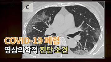 코로나바이러스폐렴(COVID-19) X-Ray와 CT 이렇게다르다!!