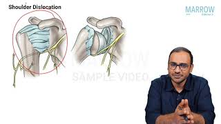 Orthopaedics : Anterior dislocation of shoulder - Marrow Edition 5 (Clinical Core) Sample Video