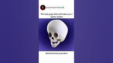 Skull Distractor Procedure #3danimation #doctor #shorts #shortsfeed #skull #youtubeshorts #medical