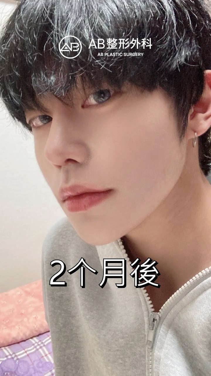 男生鼻整形前後對比變化超大 #shorts