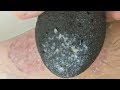 A NEW STONE || LAVA PUMICE STRIKES BACK || RETURN OF THE FLAKE GUY [Psoriasis]