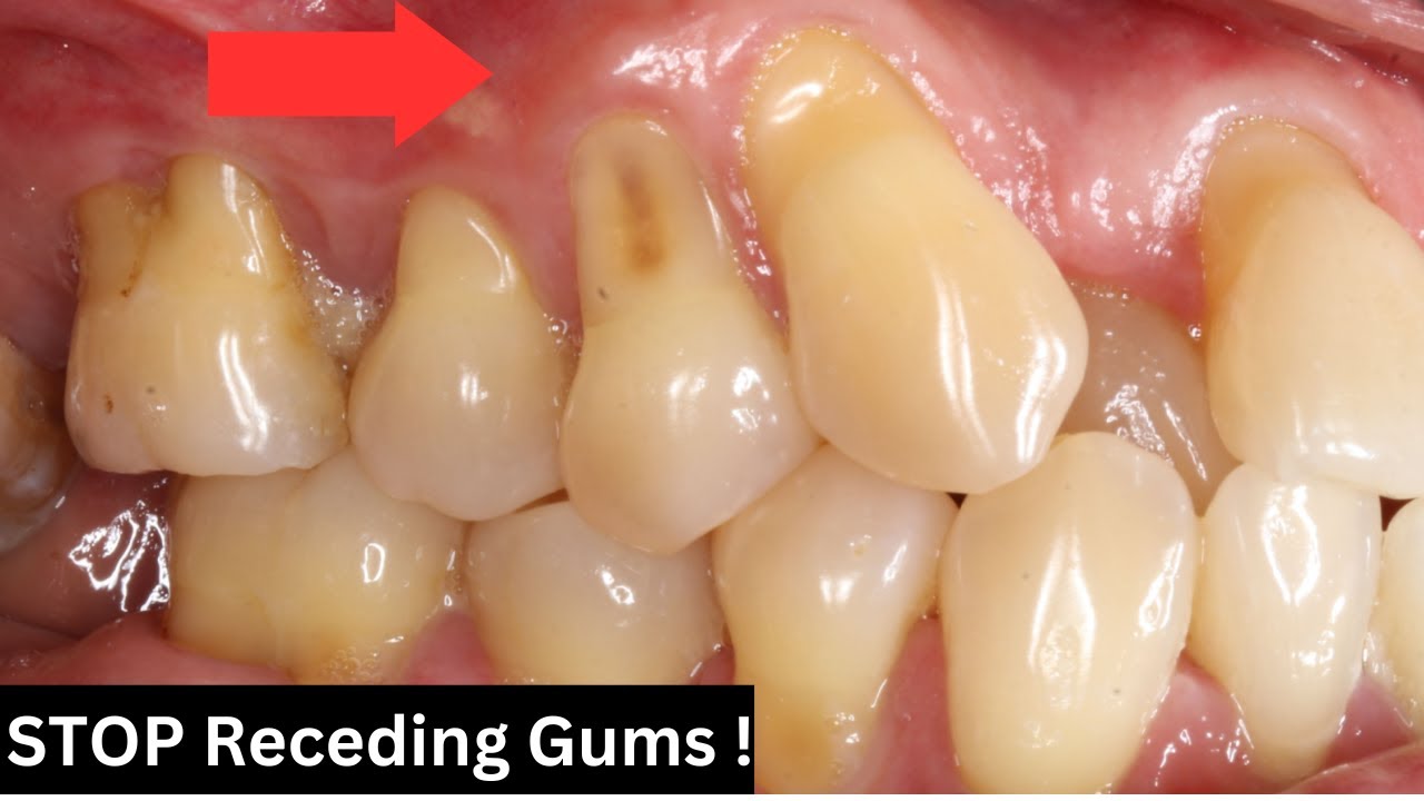 "5 Ways to Stop Gum Recession from Getting Worse | Causes and Symptoms